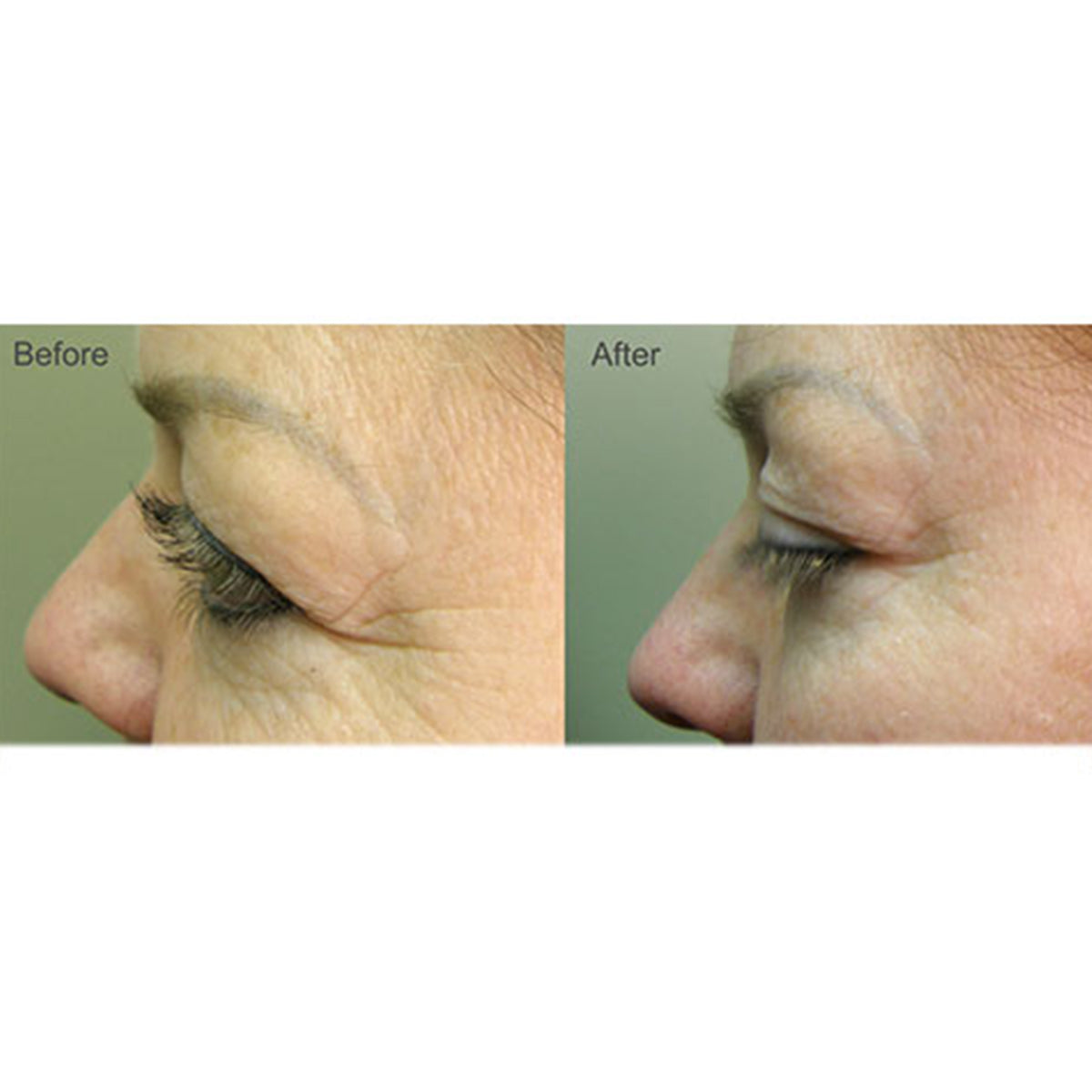 Full Face Professional Light Therapy System - image 5