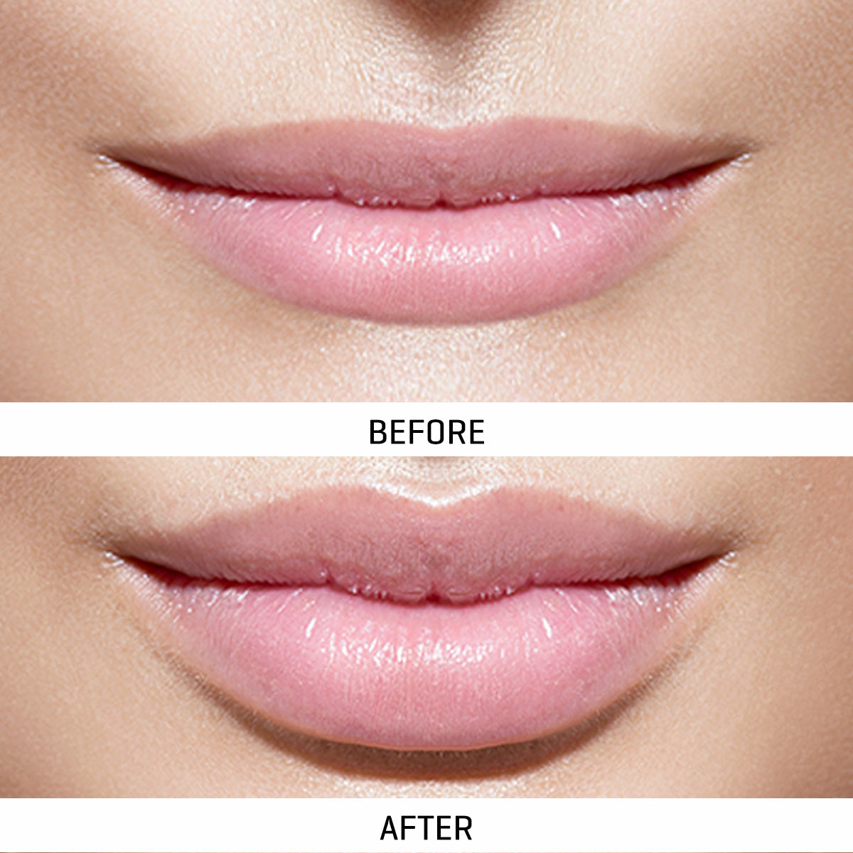World's First At-Home Professional LED Lip Therapy Device - image 2