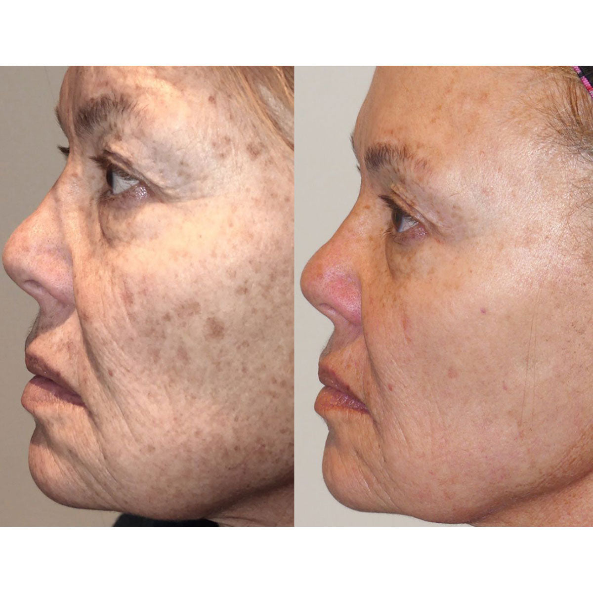 Blemish & Hair Removal Device - image 5