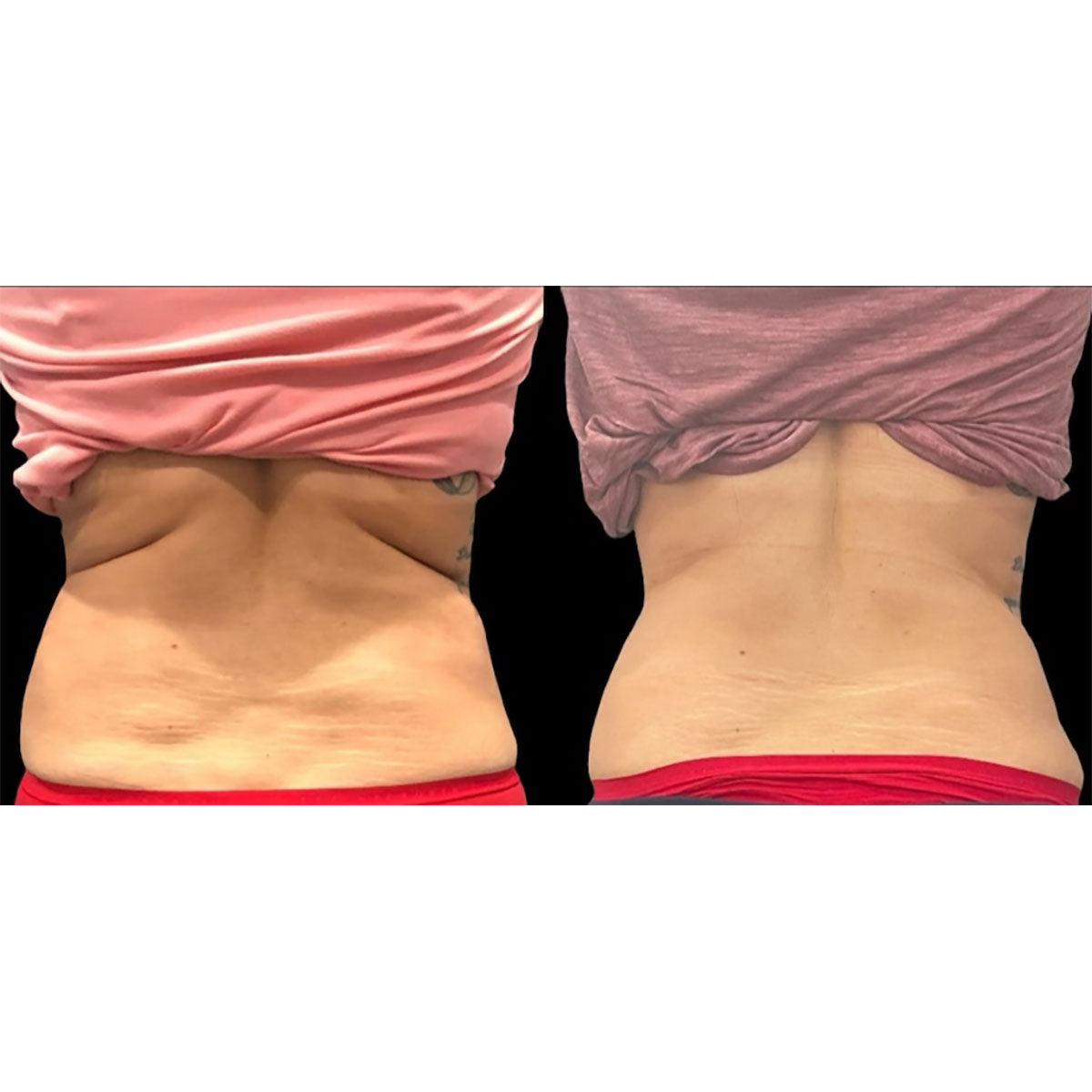 5-in-1 Body Contouring Device - image 7