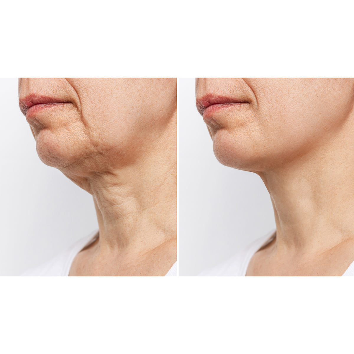 Wrinkle Reducing Neck Therapy Device - image 7